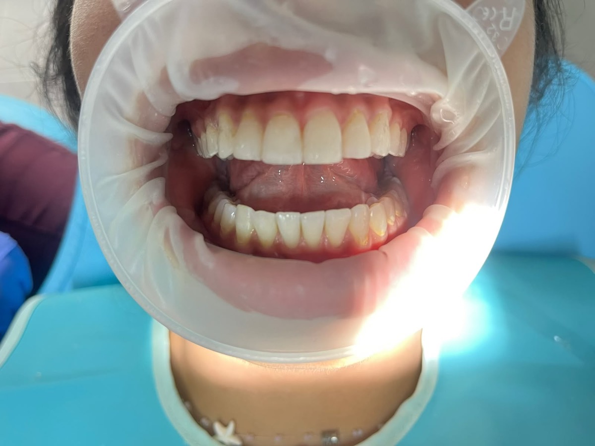 Sonrisa después del tratamiento