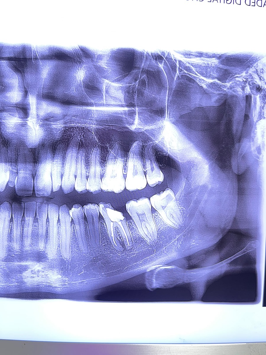 Radiografía panorámica